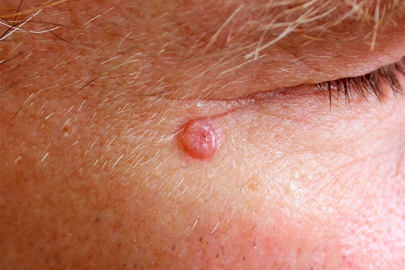 carcinoma-basocelular.jpg